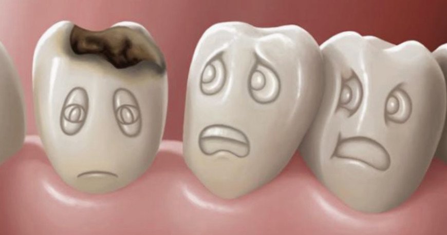 Conoce más sobre las caries