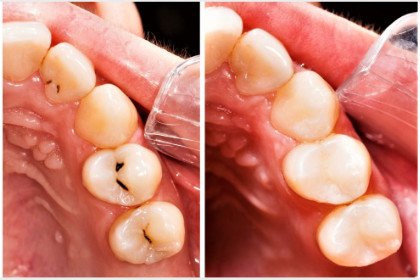 dientes con caries
